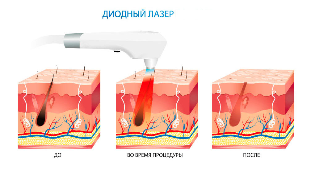 Эпиляция диодным лазером