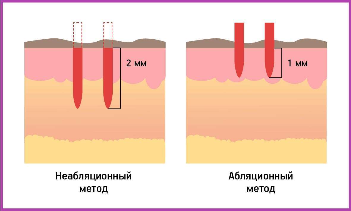 Отличия абляционного и неабляционного методов