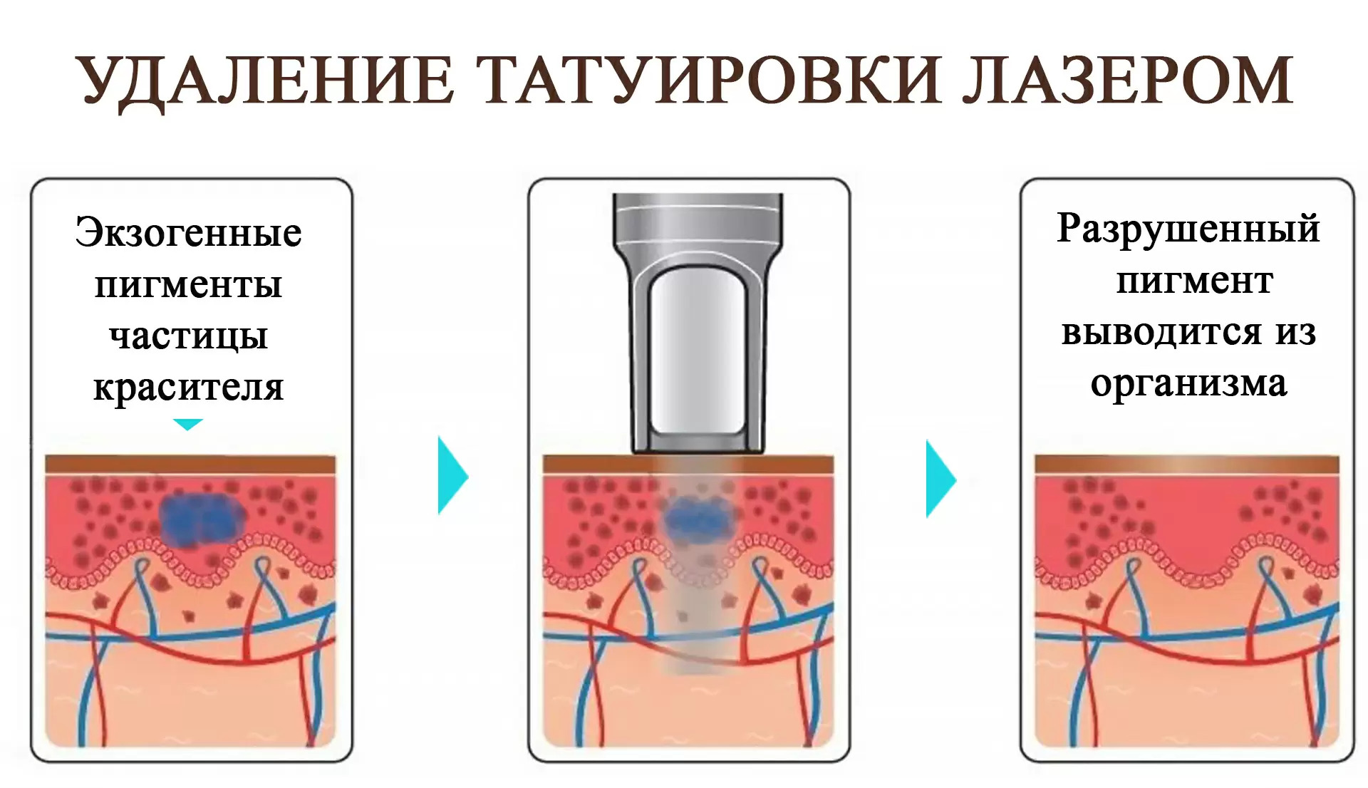 удаление татуировки с помощью лазерного оборудования 